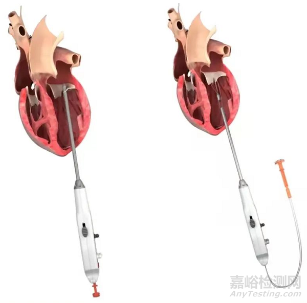 心脏瓣膜之二尖瓣技术解析
