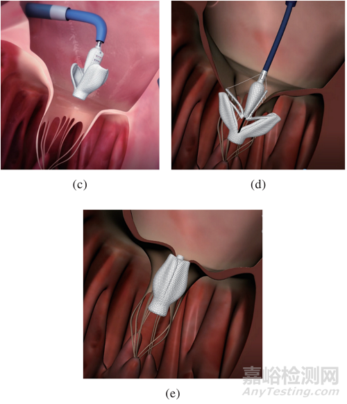 心脏瓣膜之二尖瓣技术解析