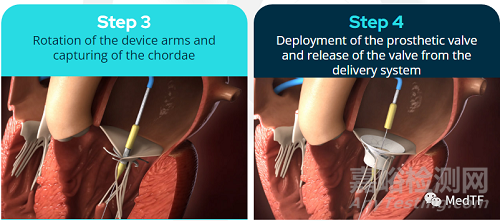 innostay：螺旋固定的二尖瓣置换产品可以适用各种大小生理结构