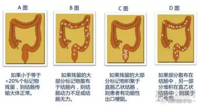 江苏唯德康“胃肠标记物胶囊”获NMPA批准上市！