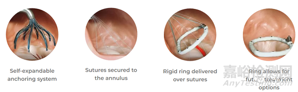 VALFIX：基于多线缝合的经导管二尖瓣瓣环
