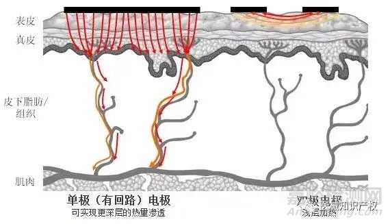 热玛吉技术解析