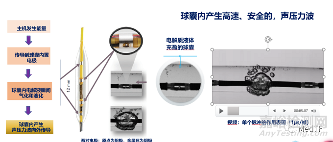 Shockwave IVL血管内冲击波产品获NMPA批准