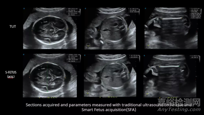 开立生物发布第四代人工智能产前超声筛查产品“凤眼S-Fetus”