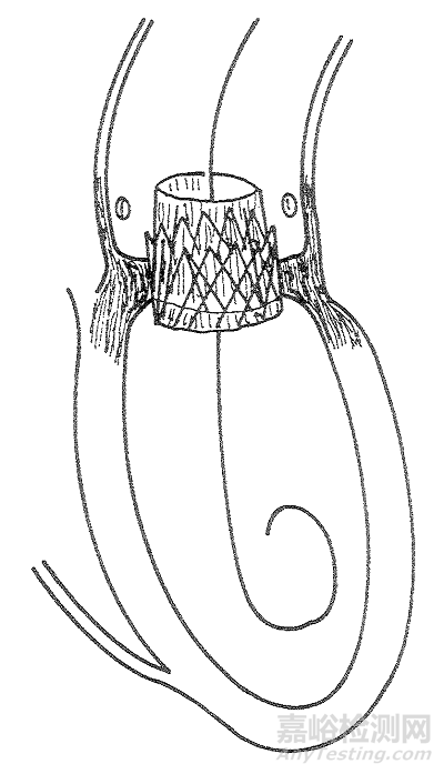 心脏瓣膜技术解析