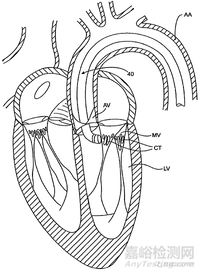 心脏瓣膜技术解析