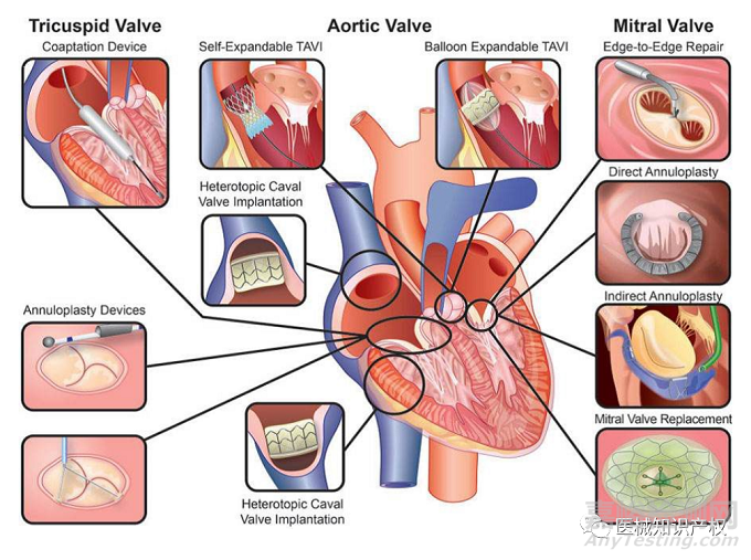 心脏瓣膜技术解析