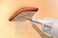 Cell Pouch：潜在糖尿病治愈技术 无需注射胰岛素