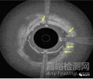 FLEX Vessel Prep：更具持久动通畅动静脉内瘘解决方案