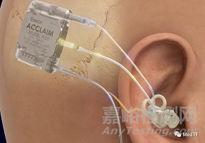 Acclaim：颠覆性完全可植式人工耳蜗获FDA批准IDE研究并开启临床研究