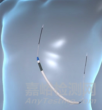 ISSD：可充电无导线植入式皮下除颤器 门诊即可完成手术