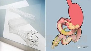 EndoBarrier：最新研究显示治疗Ⅱ型糖尿病和肥胖的患者效果积极