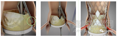 ShortCut：有效预防TAVR术引发冠状动脉闭塞