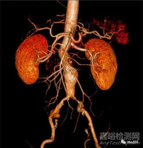 Aortoseal ：具有缝合功能的EVAR覆膜支架