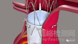 Aortoseal ：具有缝合功能的EVAR覆膜支架