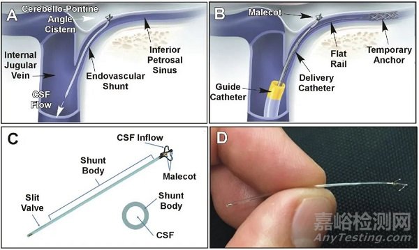 eShunt：介入脑积水分流管一年两次获FDA批准IDE研究