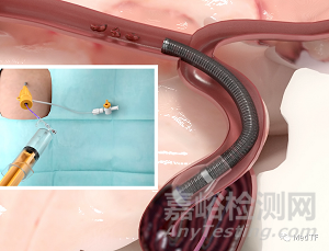 Vena BDAC：球囊+抽吸新型导管 血栓清除只需10分钟