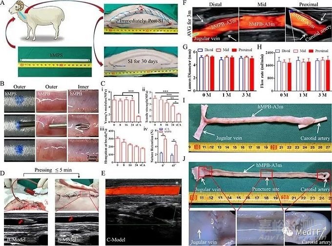 PULSSIBLE：生物型人工血管完成首例临床入组