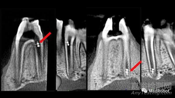 微型机器人技术应用于牙髓治疗诊断