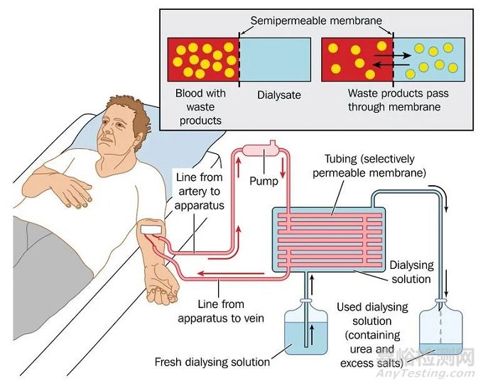 血液透析医疗器械技术与专利分析