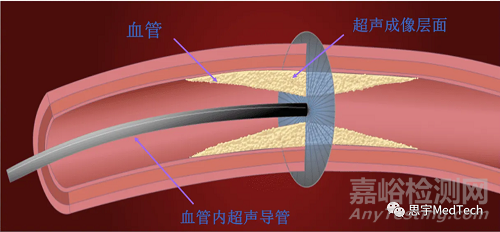 血管内超声的技术发展与代表产品