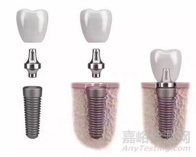 牙种植体技术与专利分析