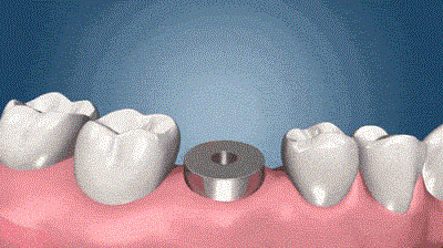 牙种植体技术与专利分析