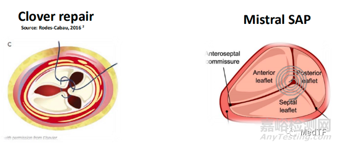 Mistral：螺旋支架修复二尖瓣和三尖瓣反流