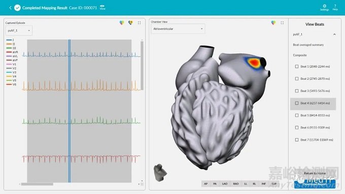 vMap：无创标测技术 平均缩短1小时电生理消融时间