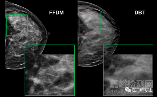 乳腺影像诊断设备及新技术进展
