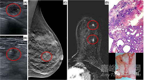 乳腺影像诊断设备及新技术进展