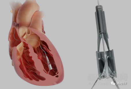 PReduction：心脏泵治疗HFpEF 无需房间隔造孔