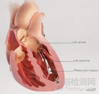 PReduction：心脏泵治疗HFpEF 无需房间隔造孔