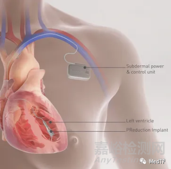 PReduction：心脏泵治疗HFpEF 无需房间隔造孔