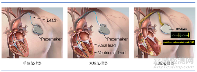 植入式心脏起搏器技术发展趋势
