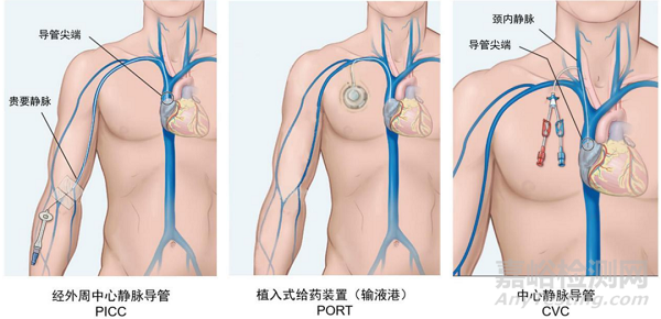 血管通路医疗器械市场情况和发展趋势