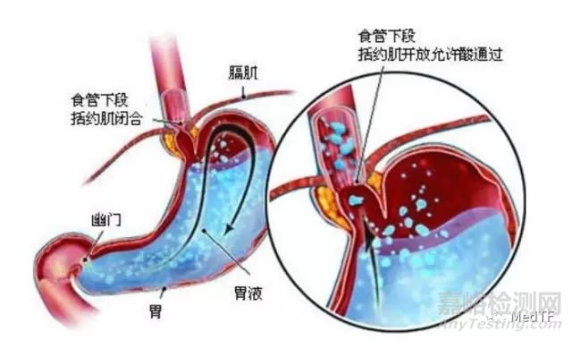 EndoStim System：电刺激治疗胃反流 获FDA授予“突破性设备”称号