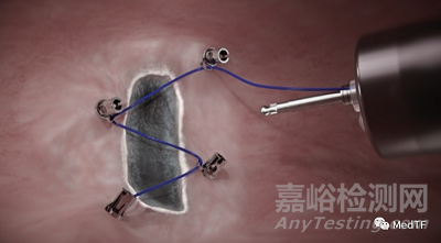 X-Tack：新一代消化内镜下大伤口止血神器