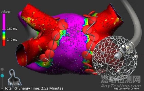 Sphere-9：美敦力电脉冲、射频、标测三合一导管完成IDE研究入组