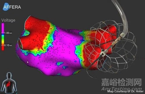 Sphere-9：美敦力电脉冲、射频、标测三合一导管完成IDE研究入组