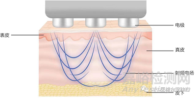 射频美容仪临床试验设计思路