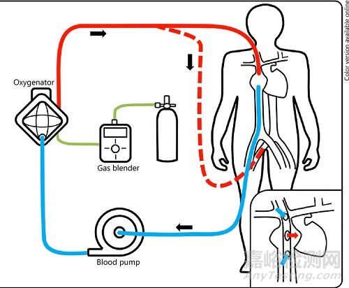 国产高性能ECMO，实现重大突破