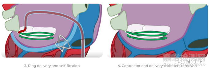 CathHELIX：经导管螺旋支架修复二尖瓣