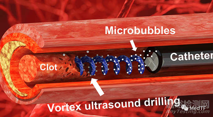 “涡流超声”：快速分解大脑中的血栓