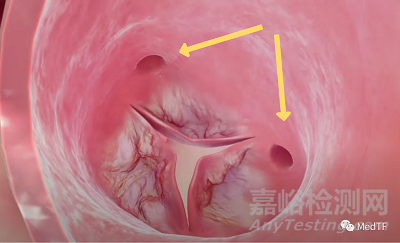 Splitter：预防TAVR引发冠状动脉闭塞的分离器