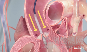 Splitter：预防TAVR引发冠状动脉闭塞的分离器