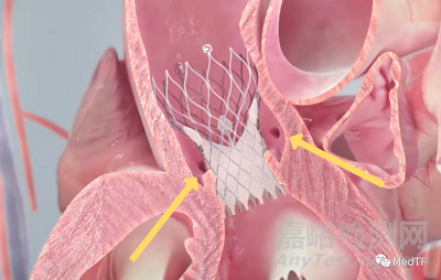 Splitter：预防TAVR引发冠状动脉闭塞的分离器