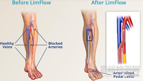LimFlow System：使76%的无治疗选择“CLTI”患者避免截肢