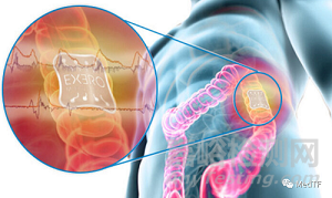 xBar：可吸收胃肠吻合口漏实时监测设备