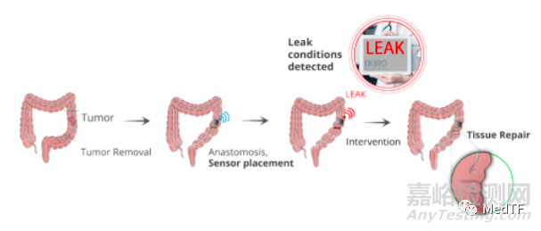 xBar：可吸收胃肠吻合口漏实时监测设备